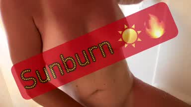 Sunburnt 🥵